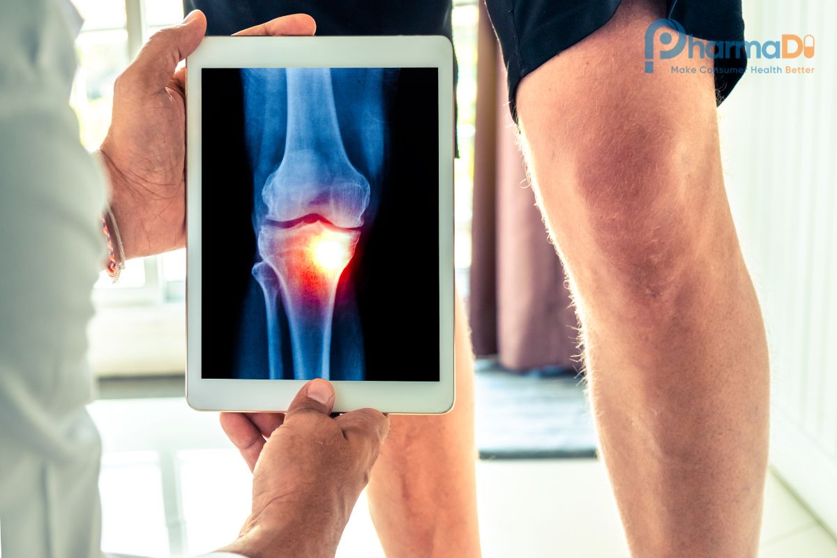 Thoái Hóa Khớp Gối: Nguyên Nhân, Dấu Hiệu Và Cách Xử Trí Hiệu Quả Tại Nhà Thuốc