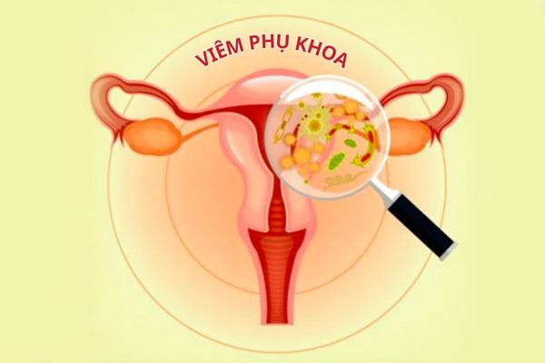 Viêm phụ khoa là từ chỉ chung tình trạng viêm tại buồng trứng, tử cung, âm hộ,...