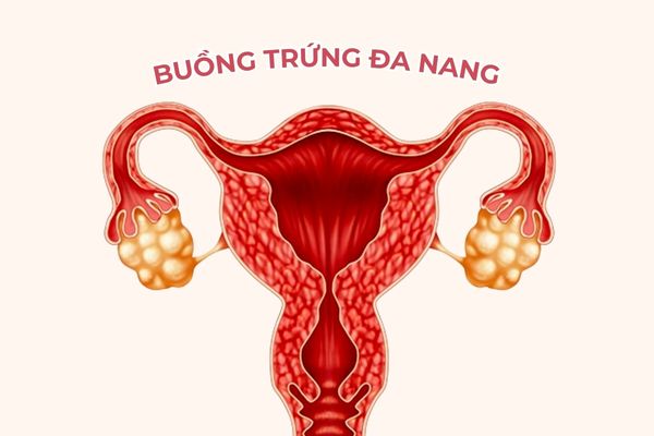 Buồng trứng đa nang là bệnh phụ khoa phổ biến liên quan đến hormone nữ