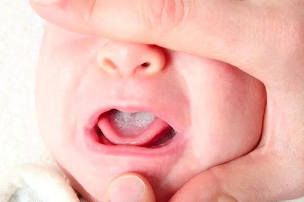Nấm âm đạo thường ít nguy hiểm nhưng có thể gây bệnh tưa miệng ở trẻ sơ sinh