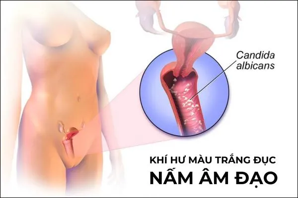 Khí hư màu trắng đục vón cục là dấu hiệu nấm âm đạo đặc trưng
