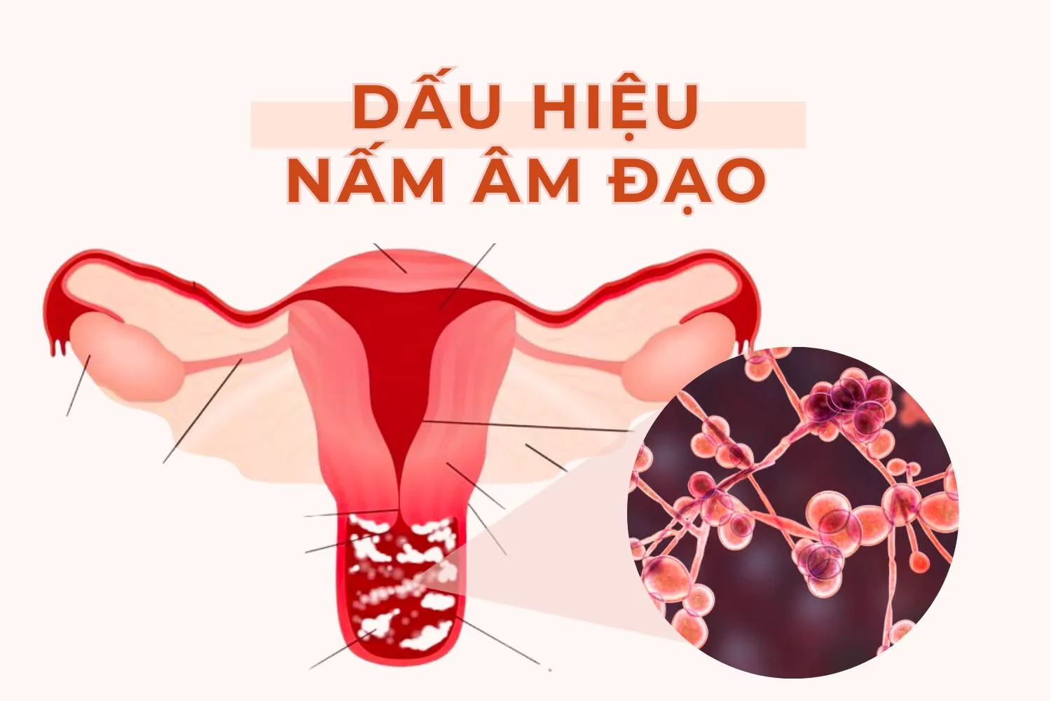 dấu hiệu viêm âm đạo