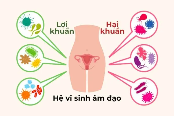 Mất cân bằng hệ vi sinh âm đạo làm nấm phát triển là nguyên nhân gây viêm âm đạo
