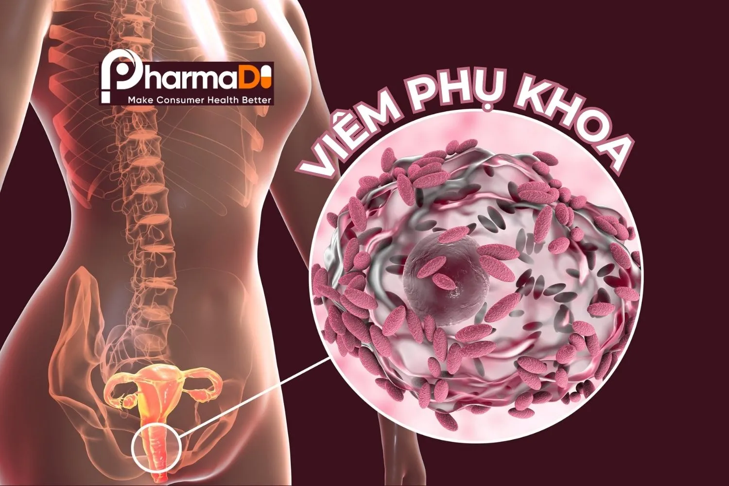 viêm phụ khoa