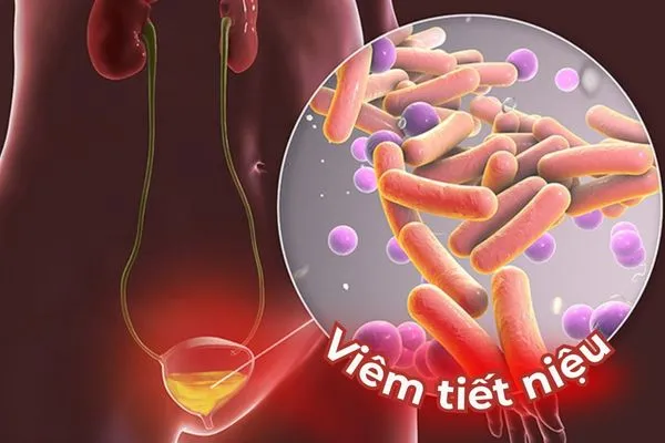 Viêm tiết niệu là bệnh lý viêm nhiễm phổ biến, đặc biệt là ở nữ giới