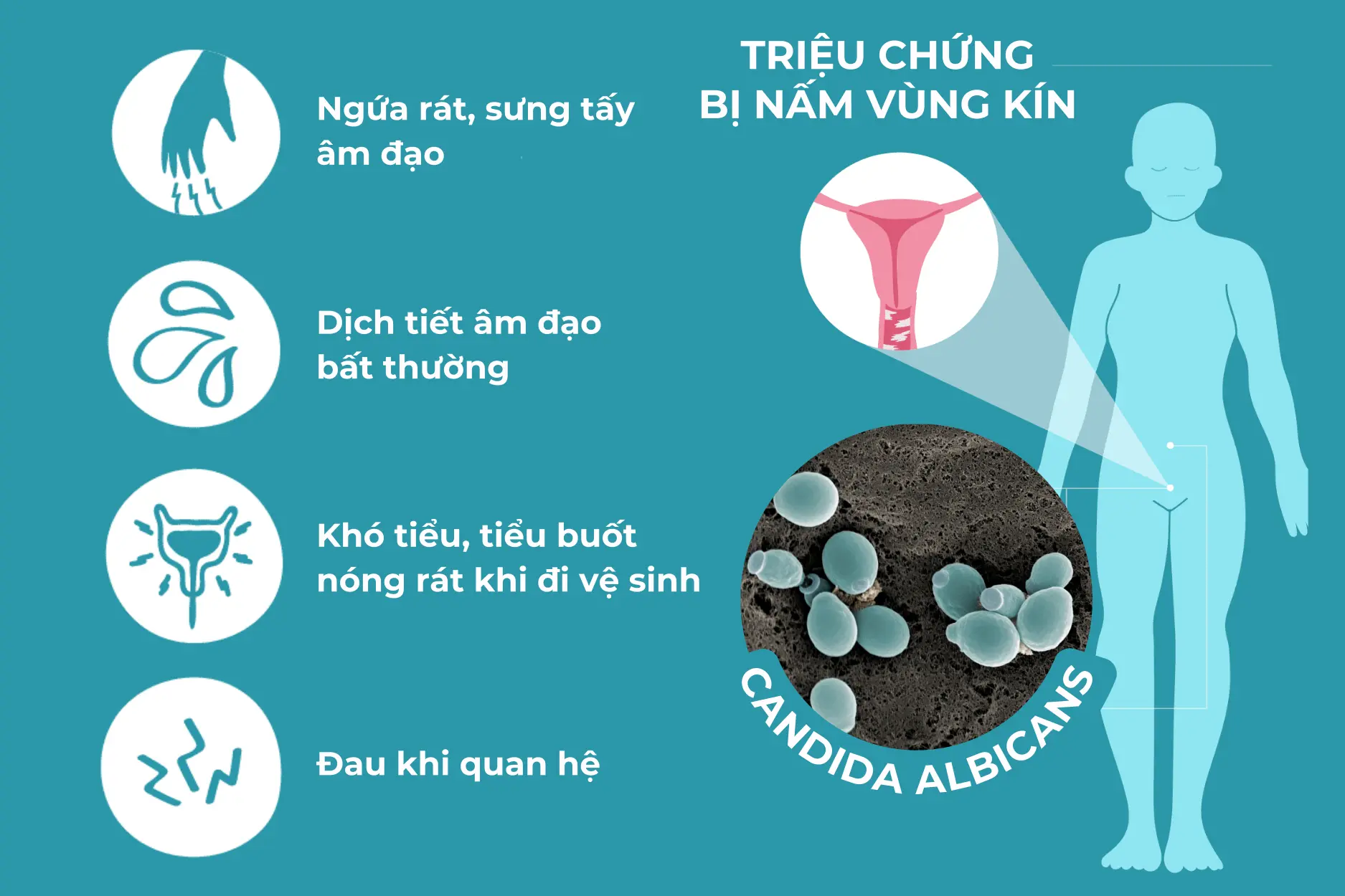 Các triệu chứng nhiễm nấm Candida đặc trưng