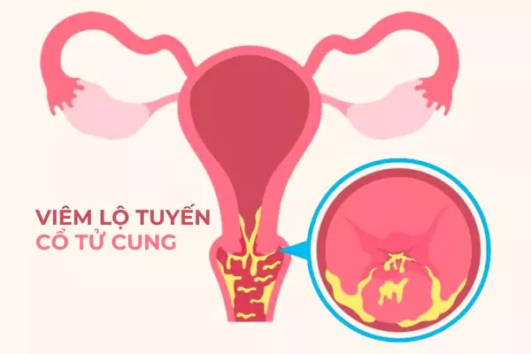 Khí hư vón cục màu vàng xanh là dấu hiệu của viêm lộ tuyến cổ tử cung