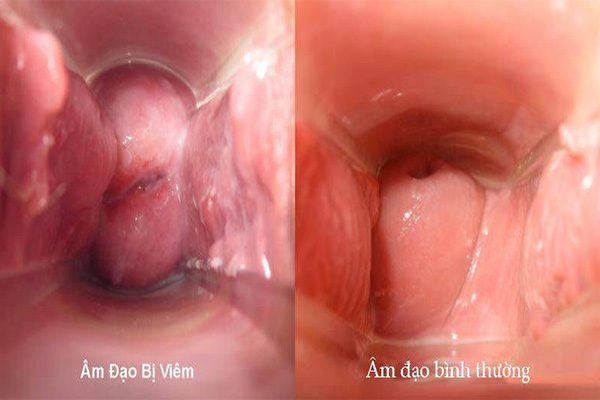 Hình ảnh so sánh m đạo bình thường và âm đạo bị viêm