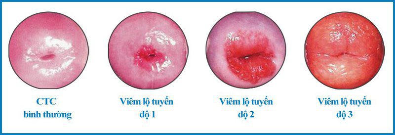 Viêm lộ tuyến tử cung