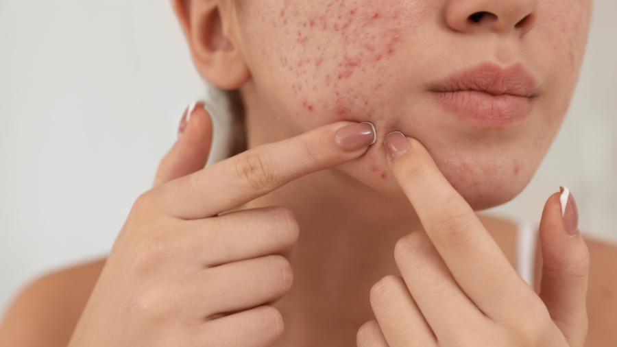 8 HOẠT CHẤT HỖ TRỢ ĐIỀU TRỊ MỤN TRỨNG CÁ HIỆU QUẢ