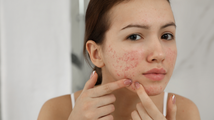 Retinoids giúp kiểm soát và ngăn ngừa mụn trứng cá hiệu quả